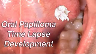 Oral Papilloma Development Time Lapse Oral Wart [upl. by Anaicul]