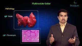 Multinodular goitre  Usmle step 1 pathology lecture and case presentation [upl. by Esyle]