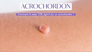 Acrochordons Excroissance de Peau  comment sen débarrasser   Skin Marceau Paris [upl. by Fred]