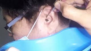 Removing Womans Earwax From Both Ears [upl. by Towill]