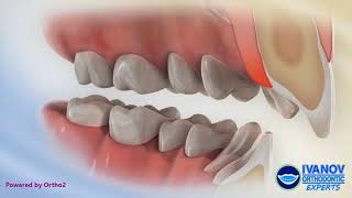 Upper 2nd Bicuspid Extraction  Overjet  Orthodontic Treatment [upl. by Barger]