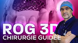 Chirurgie implantaire guidée après ROG 3D [upl. by Eidas510]