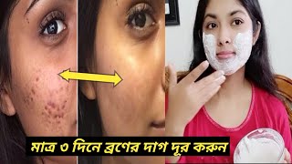 ৩ দিনে ব্রণের দাগ দূর করার উপায়। Remove acne  pimple dark spots Broner dag dur korar upayFACEPACK [upl. by Cosetta]