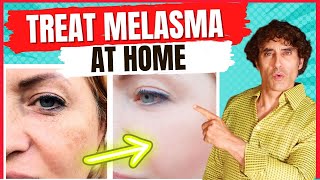 How to Treat MELASMA  Treat DARK SPOTS amp PATCHES on The SKIN [upl. by Englebert]