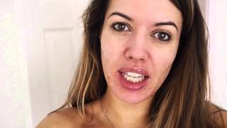 Daily Vlog  Back on Roaccutane 30mg  Month One  Super Gorgeous Blog [upl. by Nudd]