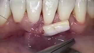 chirurgie muccogingivale type greffe conjonctive enfouie trt dune récession gingivale cl 2 [upl. by Raama289]