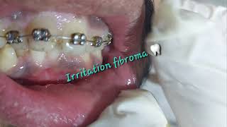 Oral benign asymptomatic prolonged irritation fibroma caused by cheek biting rubbing from teeth [upl. by Notsek542]