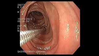 Como é feito o exame de endoscopia digestiva alta [upl. by Enetsuj361]