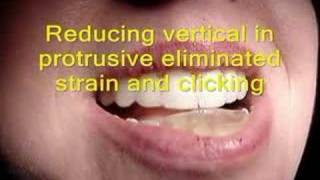 TMJ click with NTI and its resolution [upl. by Eikcaj]