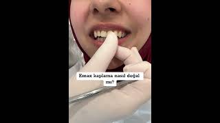 Lamine mi zirkon mu laminediş zirkonyumkaplama veneers zirkonia ciltbakımı [upl. by Shien728]