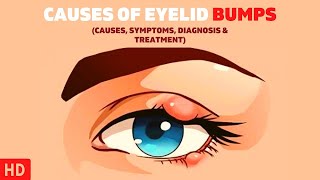 The Surprising Causes of Eyelid Bumps You Never Knew About [upl. by Murtha302]