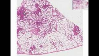 Histopathology LungBronchopneumonia [upl. by Gibrian]