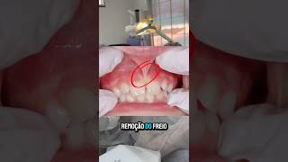 Você já ouviu falar na frenectomia e o enxerto gengival 🤔 dentes dentista [upl. by Zohara814]