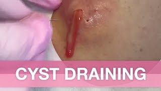 Cyst Draining  Avert your eyes if youre easy queasy [upl. by Billy]