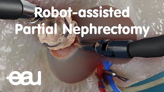 Robotassisted Partial Nephrectomy RAPN [upl. by Nivi894]