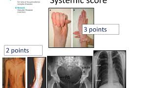 Marfan Syndrome  Diagnosis by Prof Julie De Backer [upl. by Natalya]