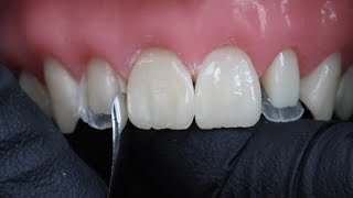 Peg Laterals Restorations with Rhodri Thomas BDS [upl. by Norda]