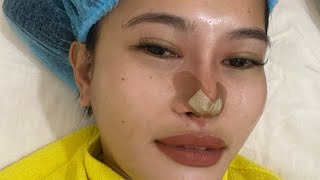 My HIKO Nose Thread Lift journey [upl. by Timmi]