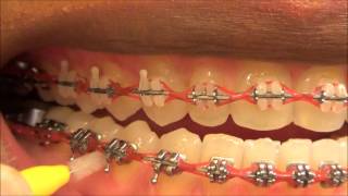 111 HOW TO USE MY INTERDENTAL TOOTHPICKS WITH BRACES ON [upl. by Notse184]