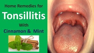 Home Remedies for Tonsillitis with Cinnamon amp Mint [upl. by Emmanuel]