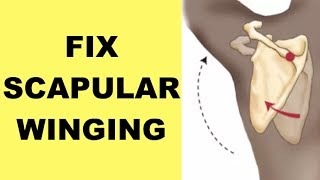 How to Fix Winged Scapula Winged Scapula Exercises [upl. by Hendel]