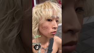 Pimples amp Pigmentation removal cream Zahira Cream pimples pigmentation shorts youtubeshorts [upl. by Torp]