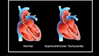 Supraventricular tachycardia [upl. by Enelrahs]