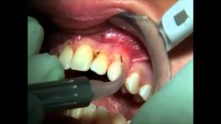 PHILIPS LASERS Gingivectomiewmv [upl. by Jump]