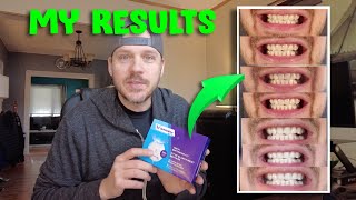 Whitebite Pro Teeth Whitening Kit Review  My 7 Day Results [upl. by Aynosal]