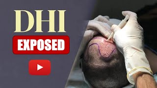 What is the DHI hair transplant SIMPLY EXPLAINED [upl. by Eversole434]