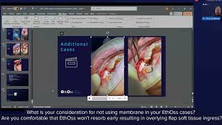 Predictable Results with EthOss Synthetic Bone Graft  More Questions amp Answers By Dr Nick Kulkarni [upl. by Sherar]