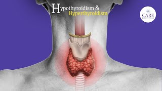 Thyroid  Hyperthyroidism amp Hypothyroidism  CARE Hospitals [upl. by Saloma]