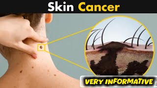 What Happen in Skin Cancer   Symptoms amp Causes and Treatment [upl. by Inahpit]