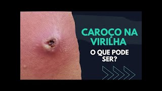 ATUALIZADO 2024 CAROÇO INTERNO NA VIRILHA O QUE PODE SER [upl. by Haywood880]