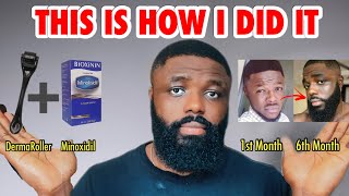 How I Used A Derma Roller And Minoxidil To Grow A Full Beard Under One Year [upl. by Annairba]