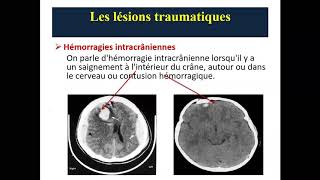 Traumatisme Cranien aux urgences  Sixième Année Médecine [upl. by Annemarie]