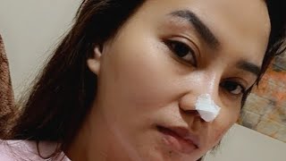 HIKO NOSE THREAD LIFT EXPERIENCE  NOSE JOB  NON SURGICAL DUBAI [upl. by Monney]