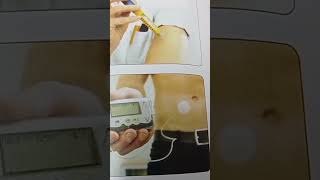 Insulin pump [upl. by Petronille]