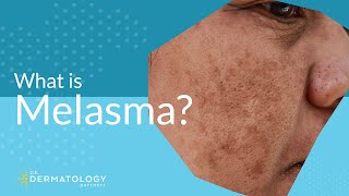 What is Melasma  Melasma Treatment Explained [upl. by Xed126]