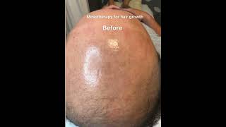 7th mesotherapy hair growth treatment [upl. by Tivad]