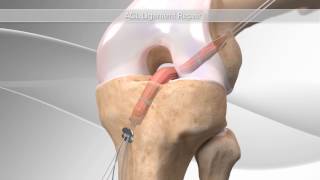 ACL Reconstruction [upl. by Pontus5]