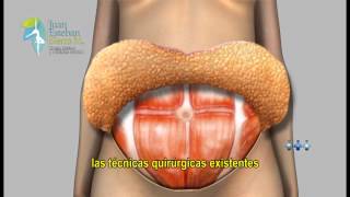 Cuidados después de una Abdominoplastía [upl. by Merilyn]