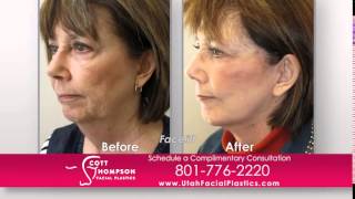 Facelift Results from Utahs Leading Facelift Surgeon [upl. by Urata819]