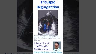 Tricuspid Regurgitation [upl. by Okin]