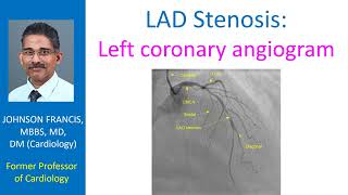 LAD Stenosis – Left coronary angiogram [upl. by Chapell]