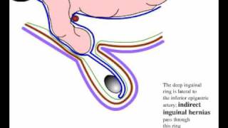 Direct and indirect inguinal hernia [upl. by Eerised]