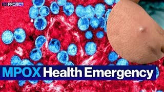 Why MPOX Is a Global Health Emergency [upl. by Africah]