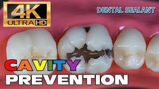 HOW TO PREVENT CAVITY DENTAL SEALANT step by step [upl. by Otxilac]