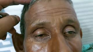 Severe ptosis in a patient with neurotoxic snake bite [upl. by Trstram]