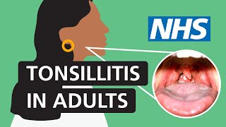 Tonsillitis in adults Symptoms and treatment  NHS [upl. by Ajna]